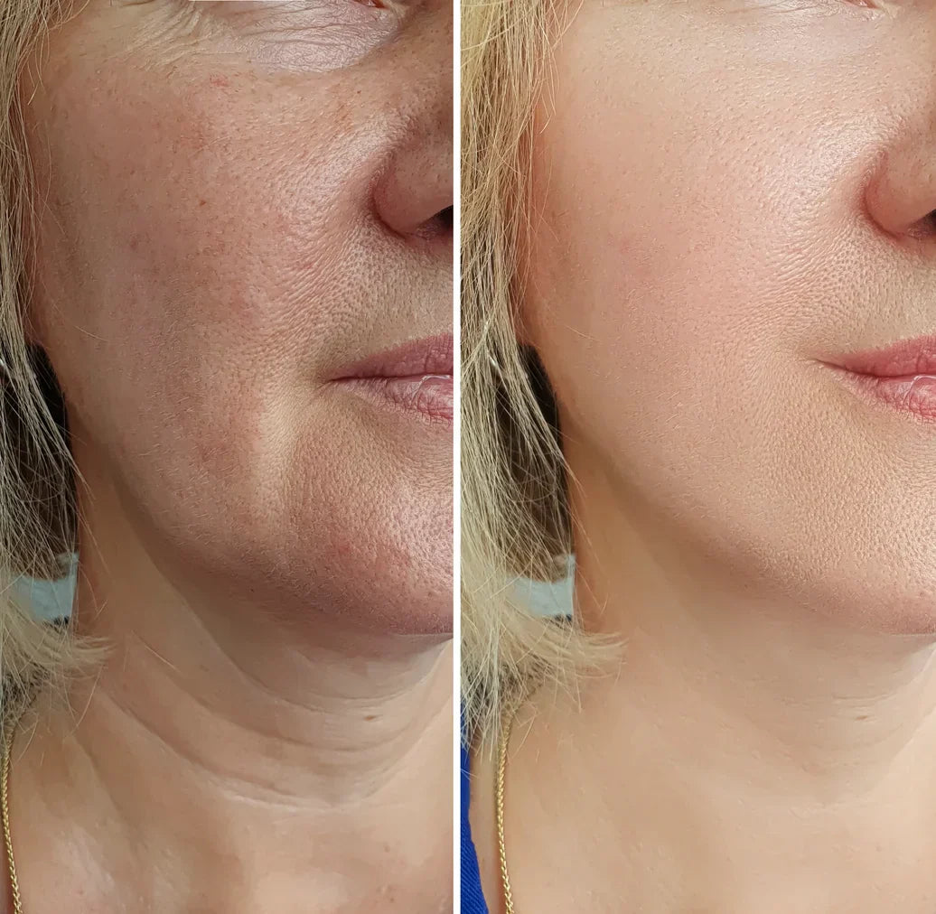 Microneedle infusion