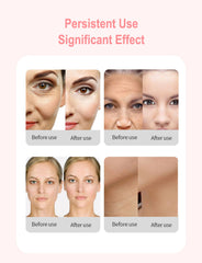 Professionele Hifu Beauty Machine