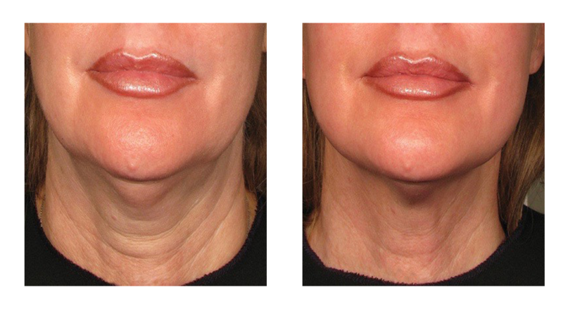 Ultrasound schoonheids- en faceliftmachine