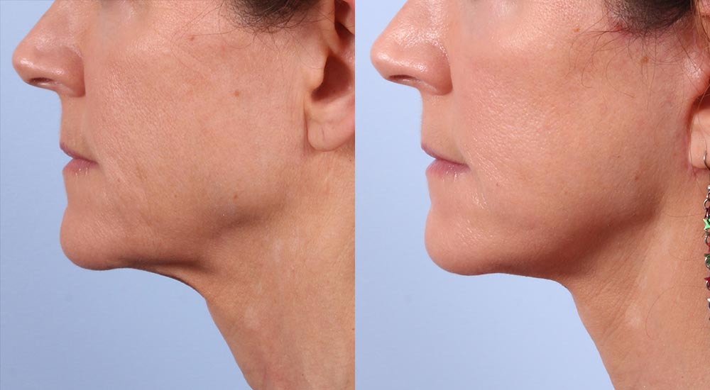 Ultrasound schoonheids- en faceliftmachine