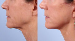 Ultrasound schoonheids- en faceliftmachine