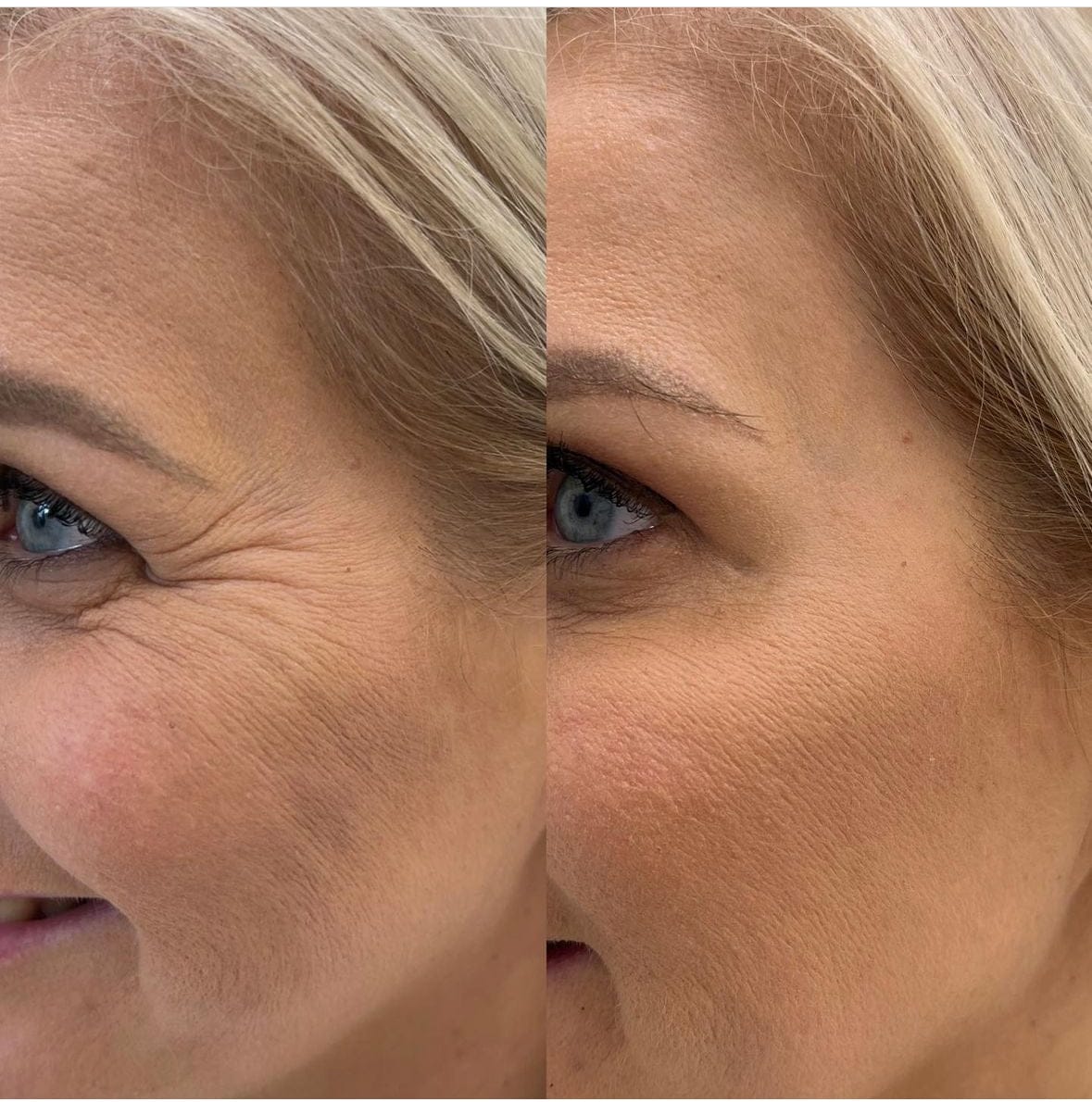 Microneedle infusion