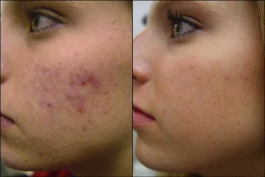 Microneedle infusion