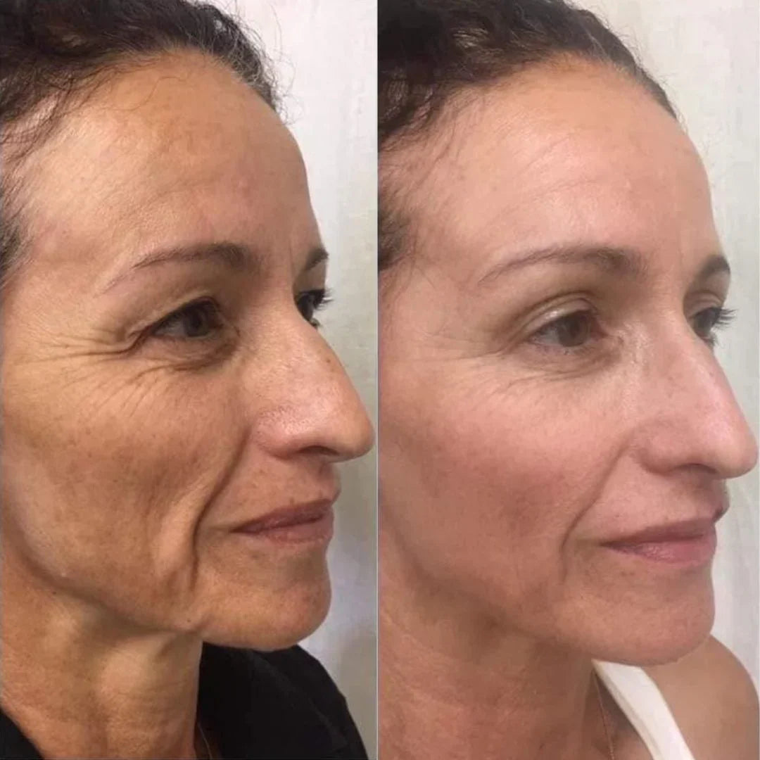 Microneedle infusion