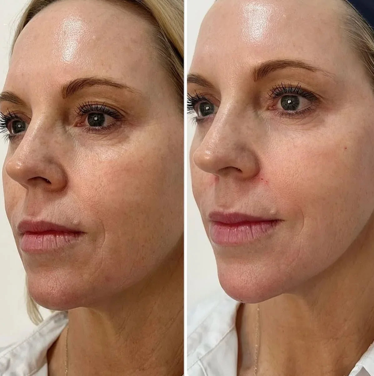 Ultrasound schoonheids- en faceliftmachine