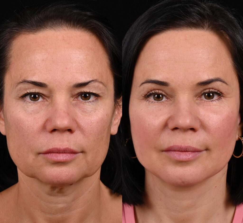 Ultrasound schoonheids- en faceliftmachine